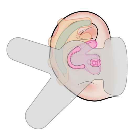 EarGear System Ear Molding - step 4