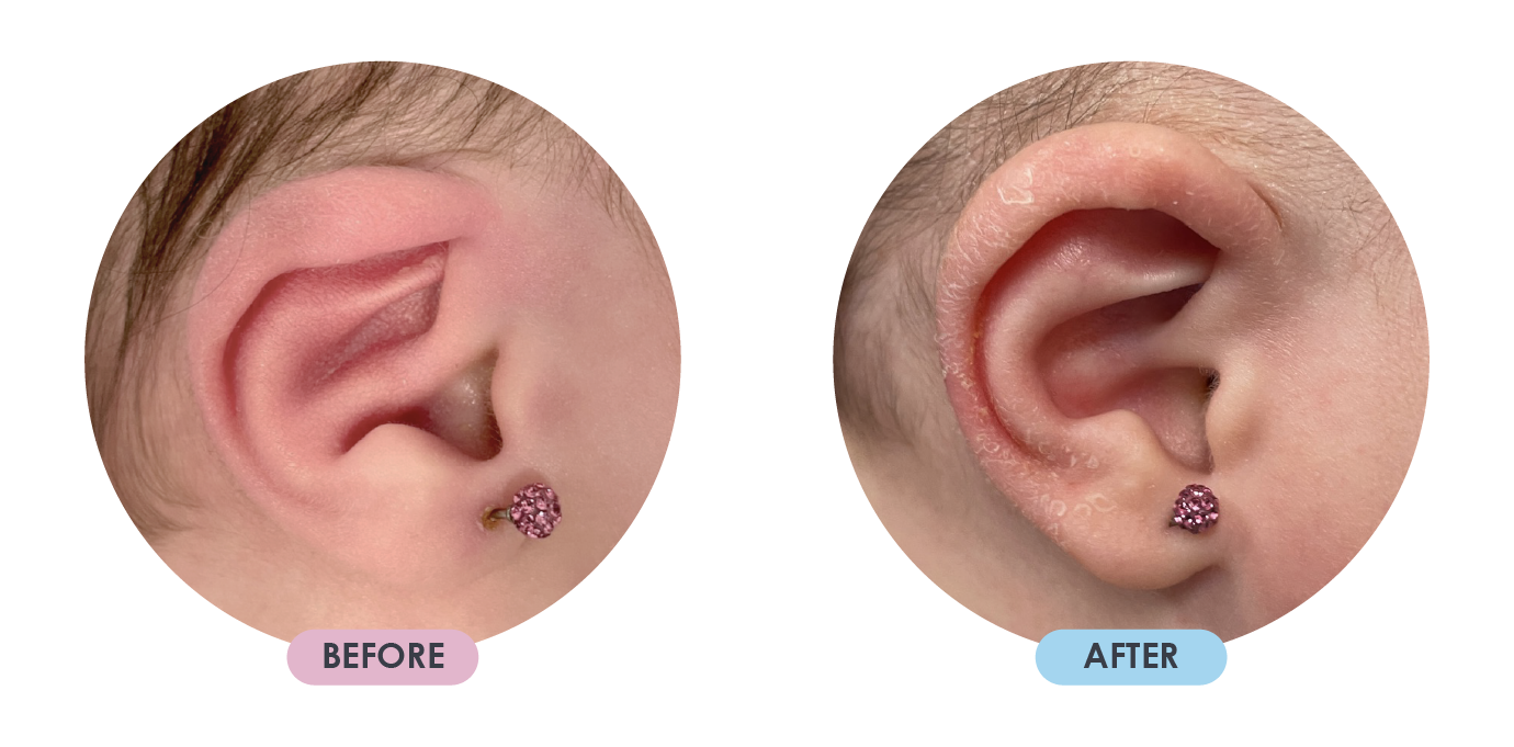 Ear Deformition