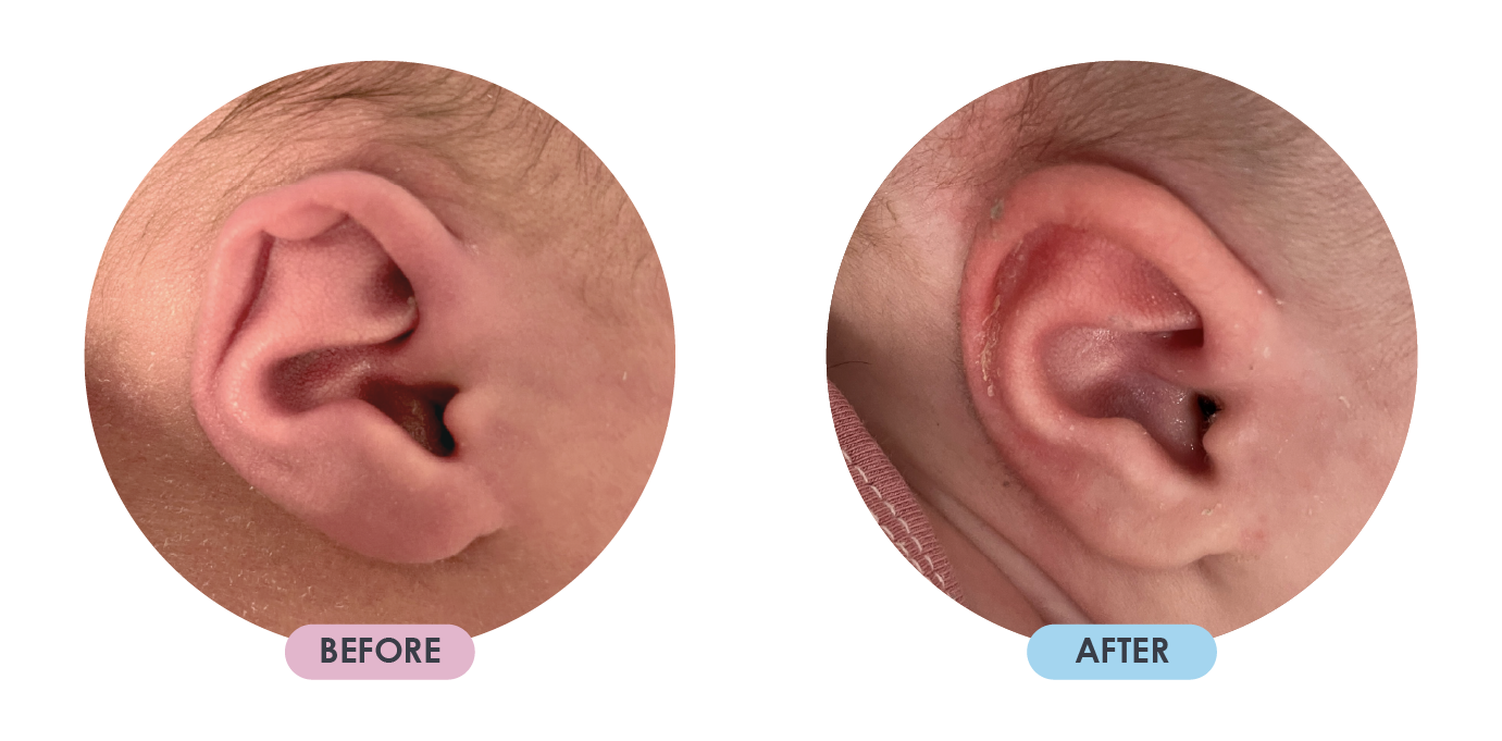 Ear Deformition 4