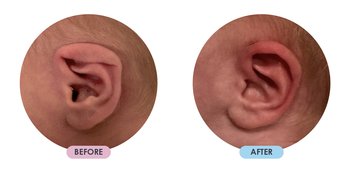 Ear Deformition 6