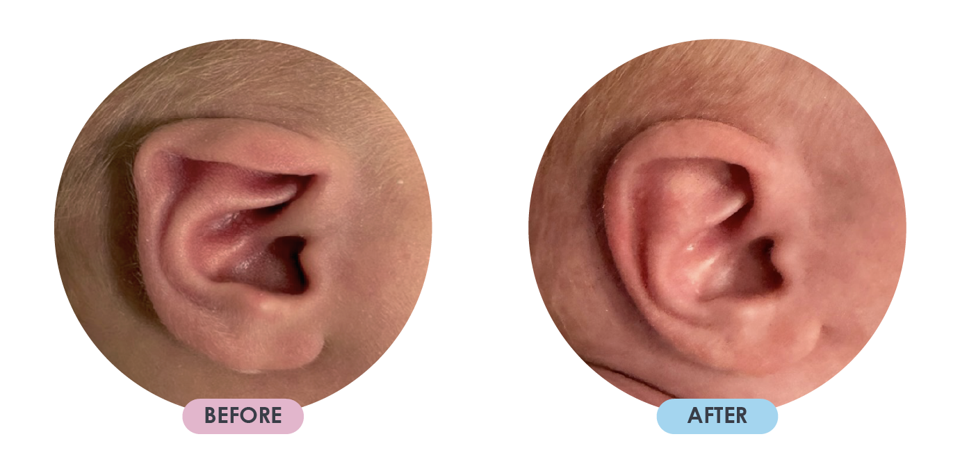 Ear Deformition 7