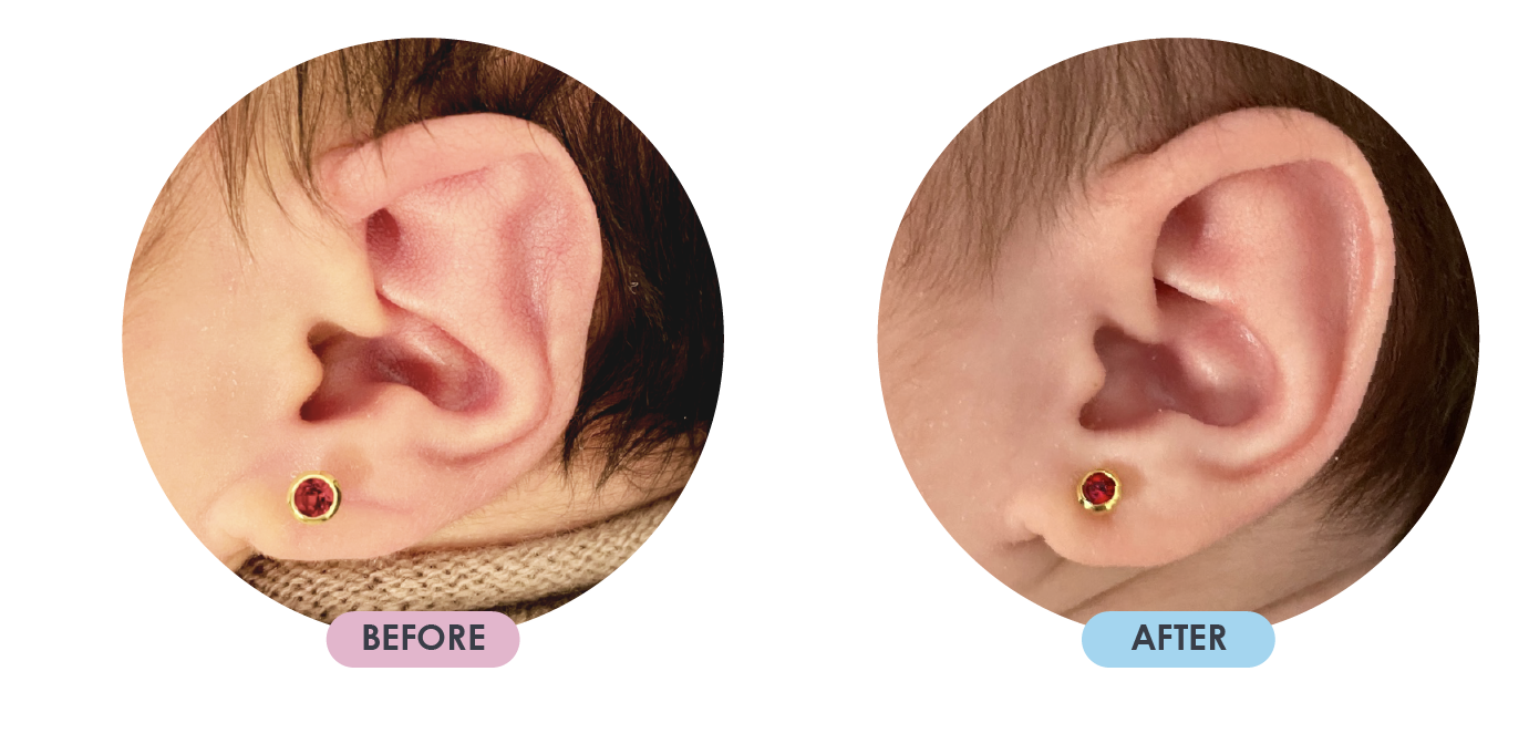 Ear Deformition 11