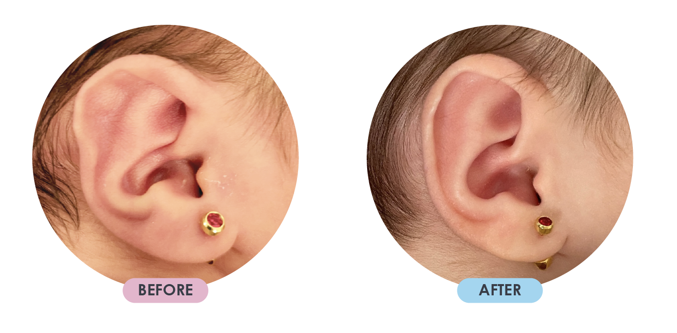 Ear Deformition 12